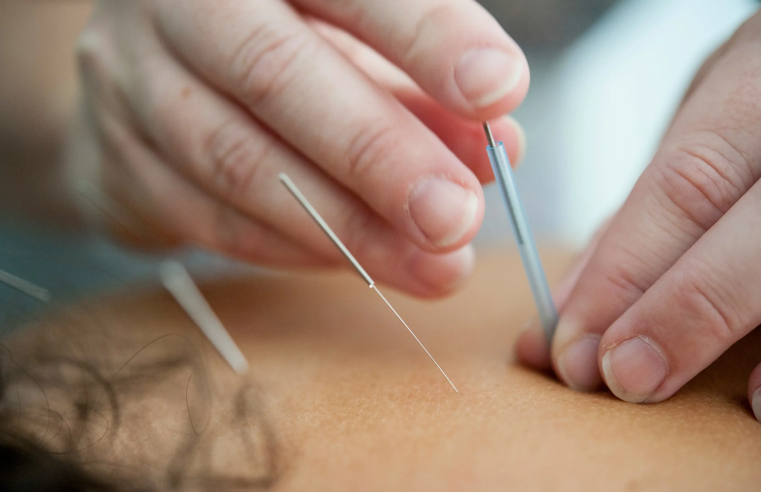 Acupuncture needles 