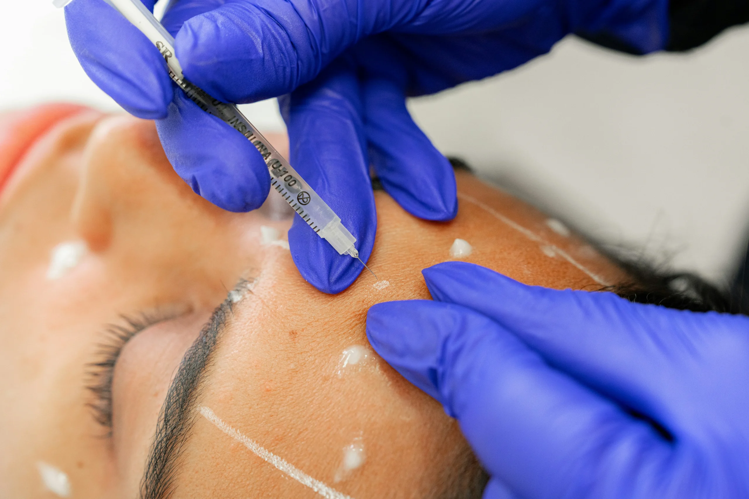 Restylane vs Other Dermal Fillers